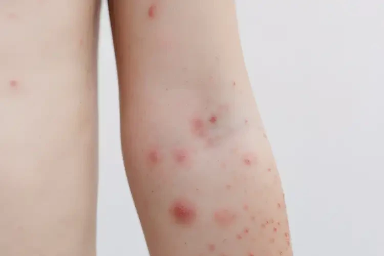 小兒全身出濕疹不管它會自己自愈嗎(圖4)