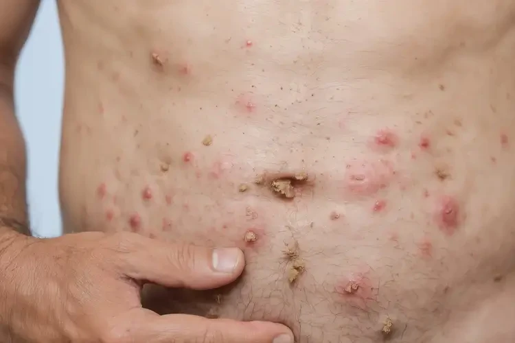 男人肚子上經(jīng)常起濕疹能夠徹底治愈嗎(圖4)