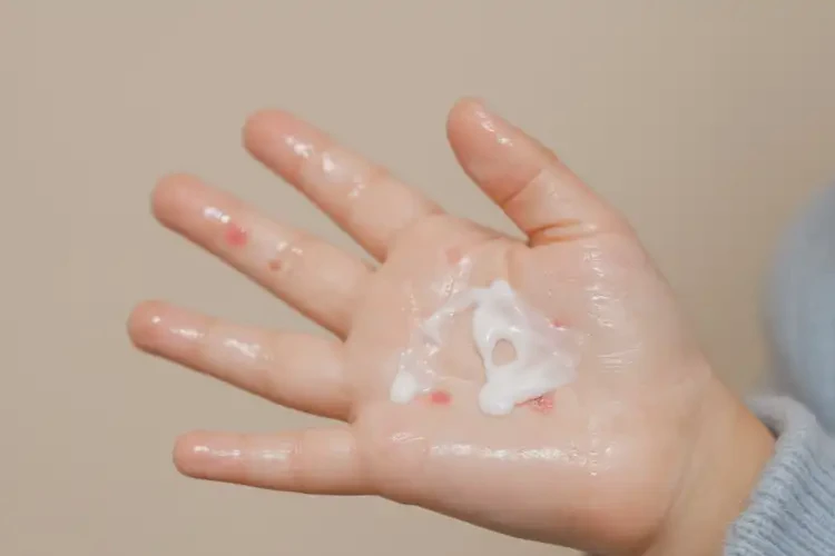 小學(xué)生手上有濕疹能靠自己自愈嗎(圖3)