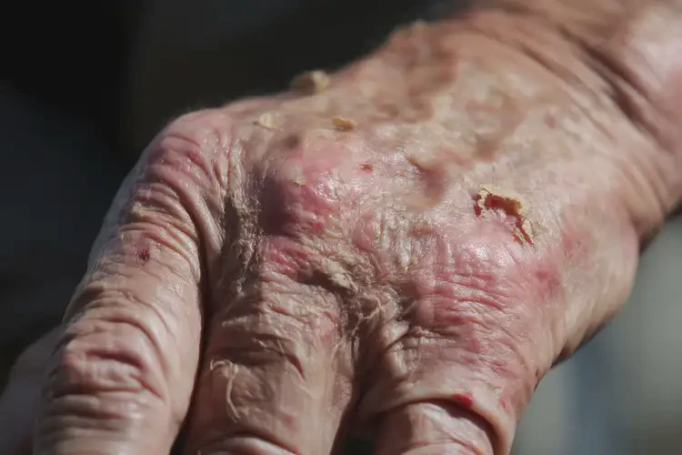 老年人手上經(jīng)常起濕疹能靠自己自愈嗎(圖4)