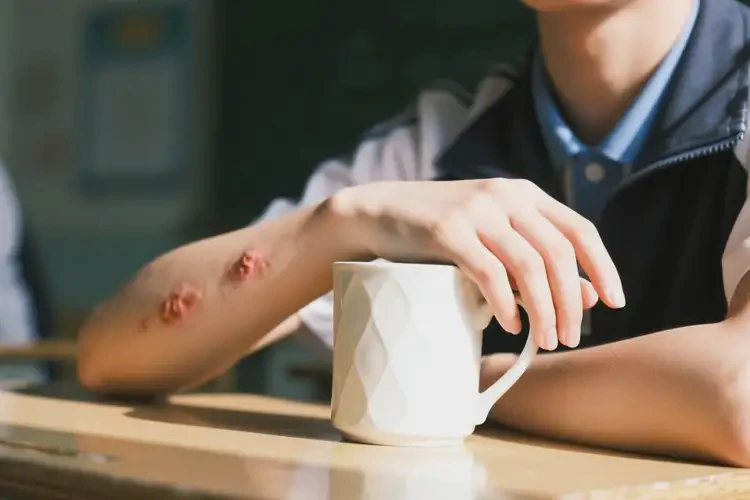 中學(xué)生手臂經(jīng)常起濕疹能靠自己自愈嗎(圖1)