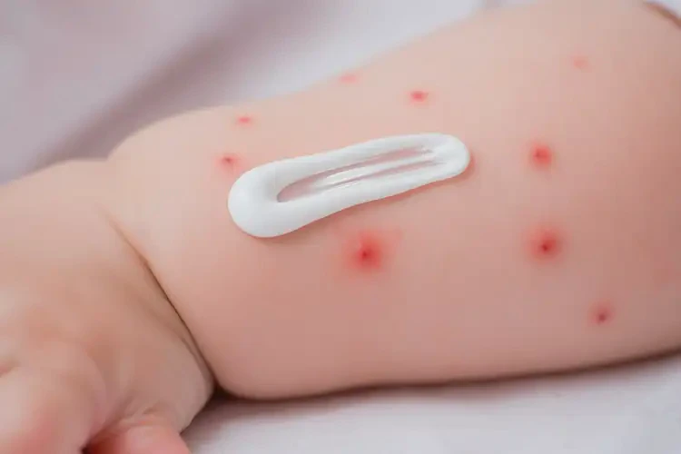 寶寶手臂上容易起濕疹不管它會(huì)自己痊愈嗎(圖2)