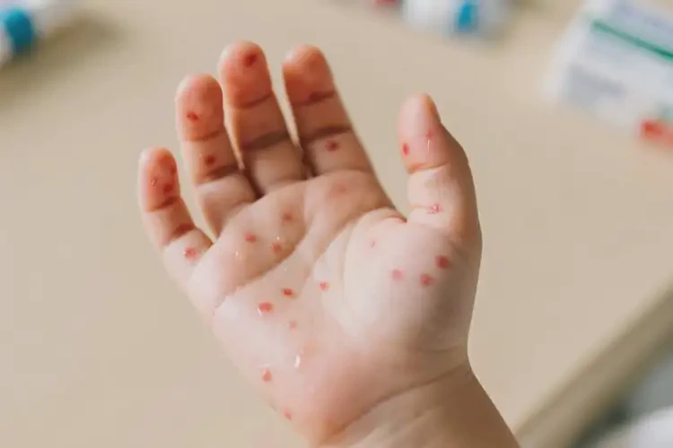 兒童手上出現(xiàn)濕疹不管它會(huì)自己自愈嗎(圖4)