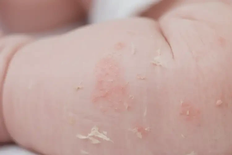 新生儿小腿上出湿疹不管它会自己痊愈吗(图4)