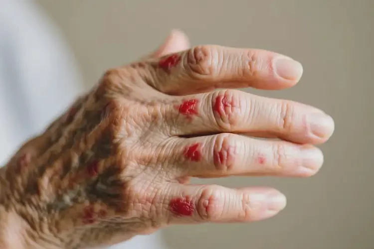 老年人四肢長(zhǎng)濕疹可以徹底自愈嗎(圖4)