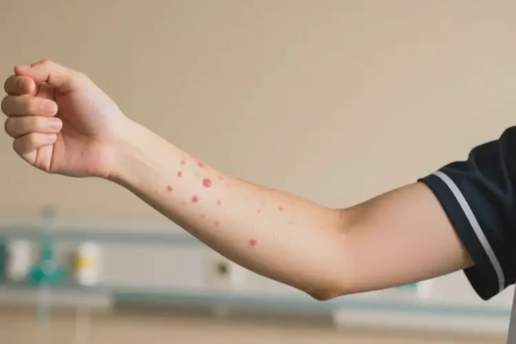 大學(xué)生手臂上偶爾起濕疹可不可以徹底自愈(圖4)