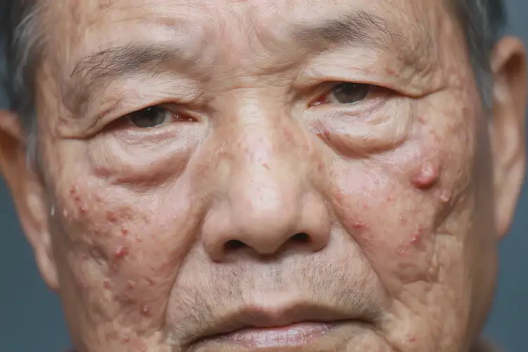 老年人面部偶爾長濕疹不管它會自己痊愈嗎(圖3)