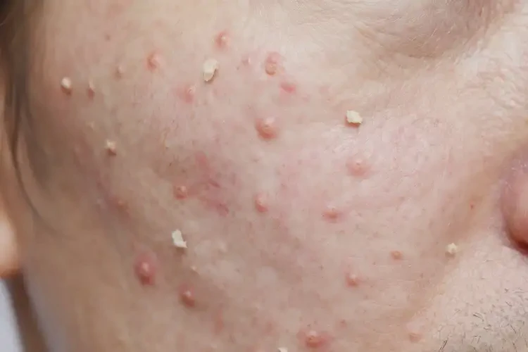 老年人四肢起湿疹不管它会自己痊愈吗(图4)