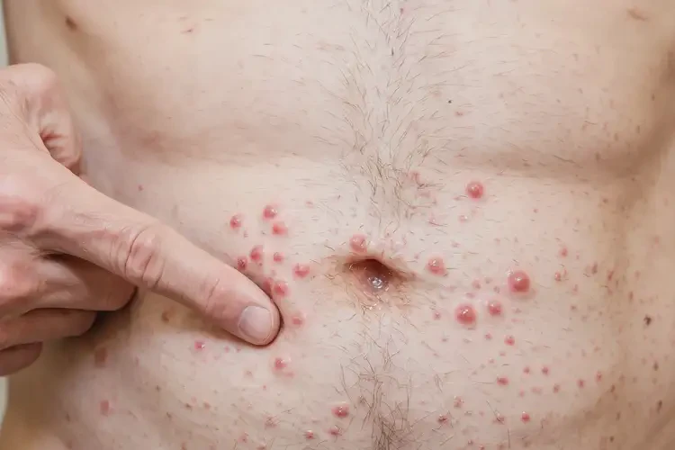 男人肚子上出濕疹不管它會自己自愈嗎(圖4)