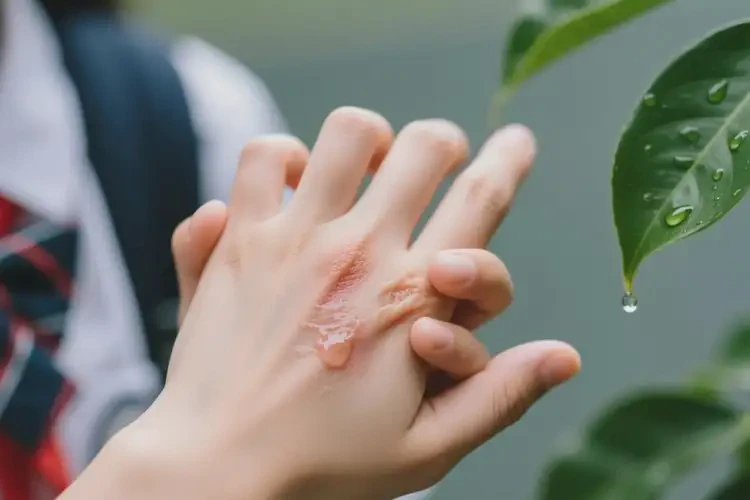 中學(xué)生手上容易起濕疹不管它會自己自愈嗎(圖2)