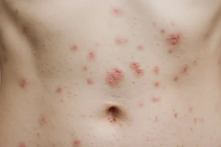 女生肚子經(jīng)常長濕疹能徹底自愈嗎(圖4)