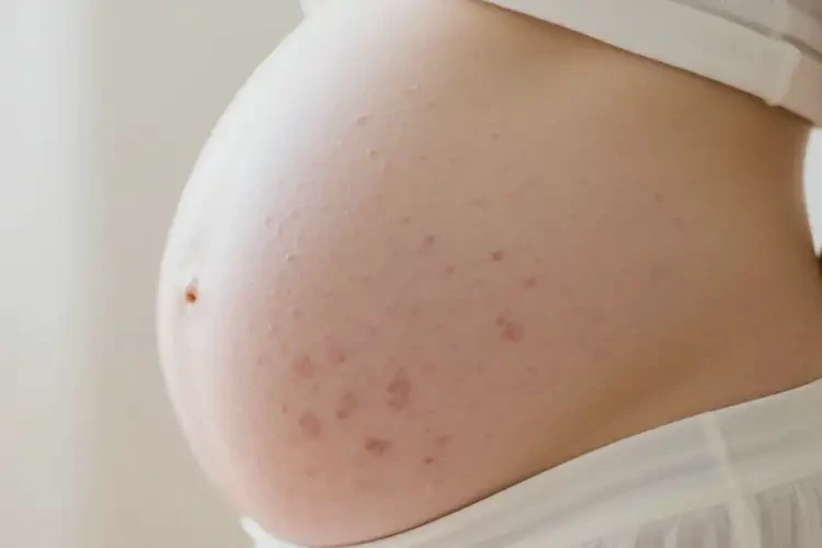 產婦肚子有濕疹可不可以徹底自愈(圖1)