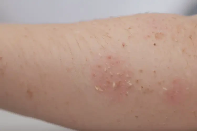 小孩手臂偶爾長(zhǎng)濕疹不管它會(huì)自己痊愈嗎(圖4)