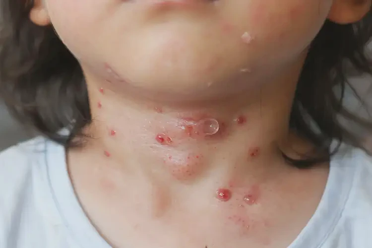 孩子脖子上經(jīng)常長濕疹可不可以徹底自愈(圖4)