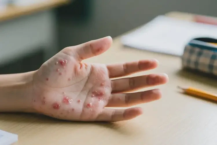 中學(xué)生手上出濕疹不管它會自己痊愈嗎(圖4)