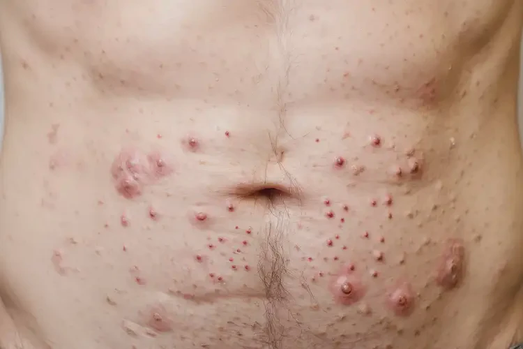 男性肚子起濕疹能夠徹底治愈嗎(圖4)