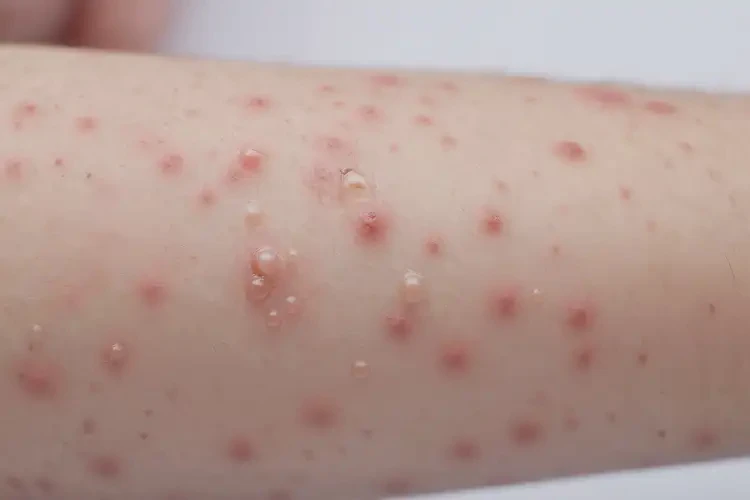 少兒身上容易起濕疹能夠徹底治愈嗎(圖4)