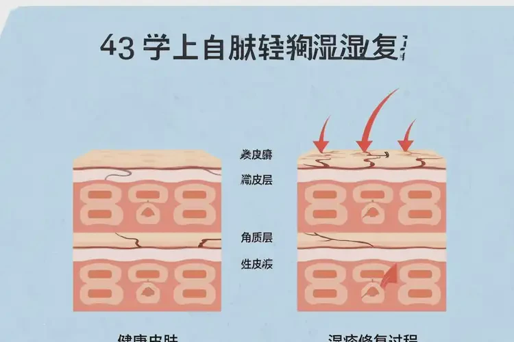 小學(xué)生四肢偶爾起濕疹不管它會(huì)自己痊愈嗎(圖4)