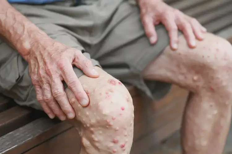 老人大腿上偶爾起濕疹不管它會自己好嗎(圖4)