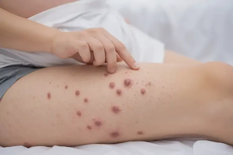 產(chǎn)婦大腿上長濕疹能徹底自愈嗎(圖4)