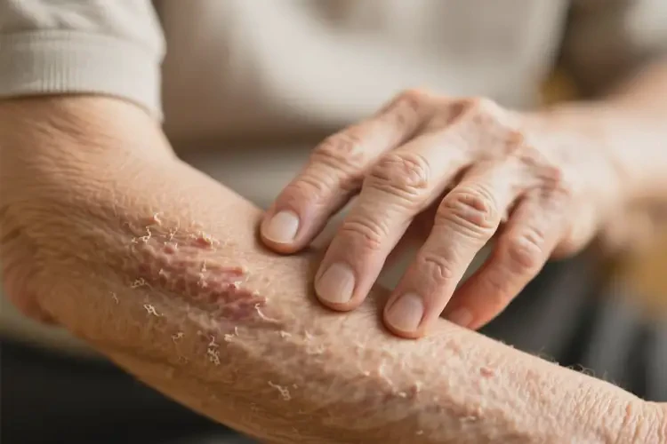 老人手臂經(jīng)常起濕疹能夠徹底治愈嗎(圖3)