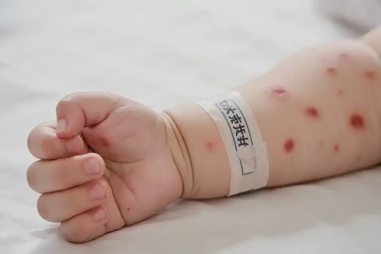 嬰幼兒手上容易起濕疹能靠自己自愈嗎(圖4)