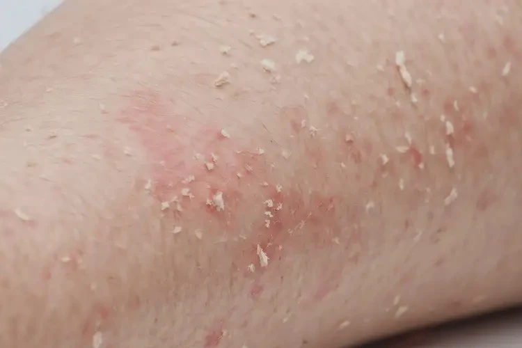 青少年大腿長濕疹能夠徹底治愈嗎(圖4)