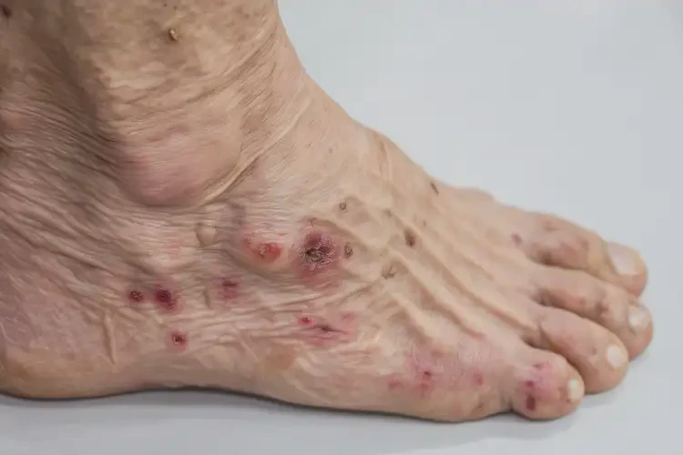 老年人腳上經(jīng)常長(zhǎng)濕疹能夠徹底治愈嗎(圖4)