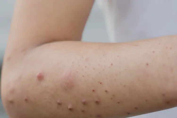 青少年手臂偶爾起濕疹可以徹底自愈嗎(圖4)