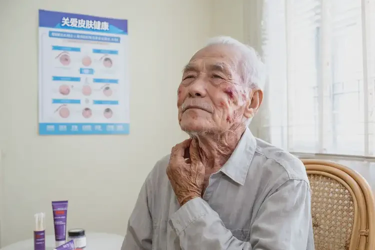 高齡老人脖子上有濕疹可以徹底自愈嗎(圖4)