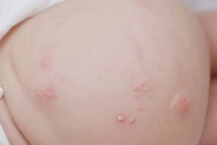 新生兒屁股經(jīng)常長(zhǎng)濕疹能徹底自愈嗎(圖4)