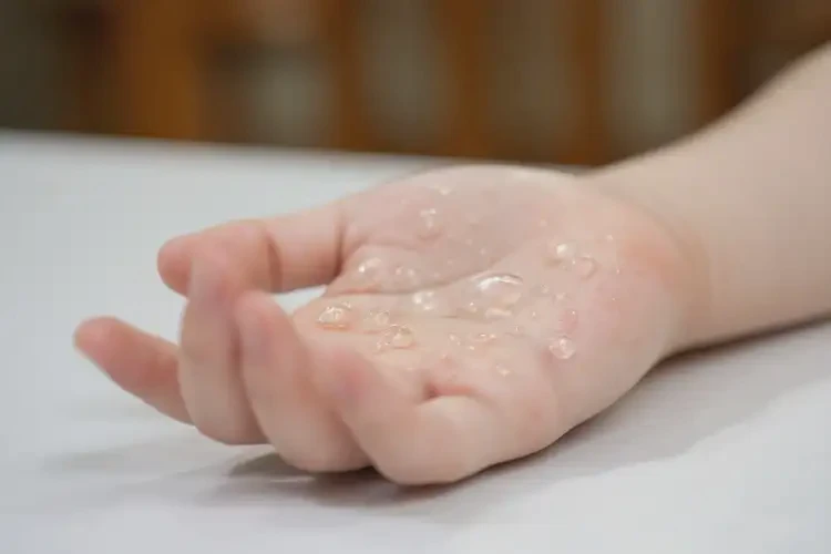少兒手上經(jīng)常長濕疹不管它會自己自愈嗎(圖2)