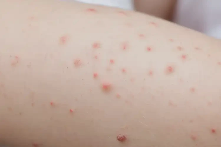 孩子手臂長濕疹可不可以徹底自愈(圖4)