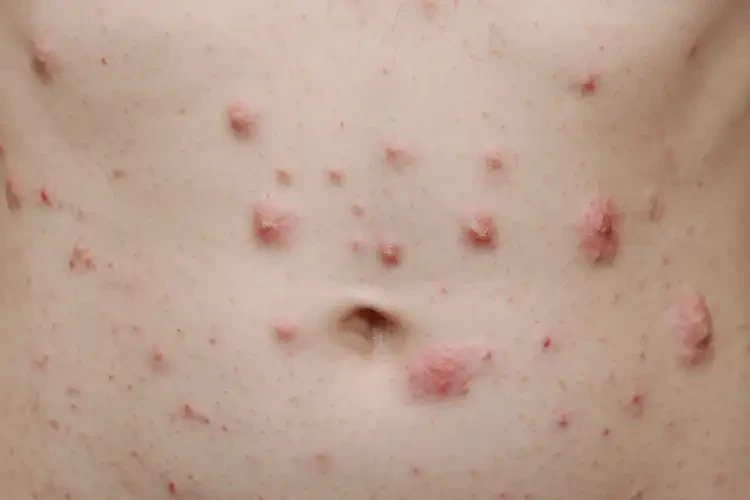 青少年肚子上容易起濕疹能夠徹底治愈嗎(圖4)