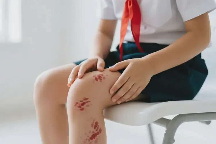 小學(xué)生大腿長濕疹可不可以徹底自愈(圖4)