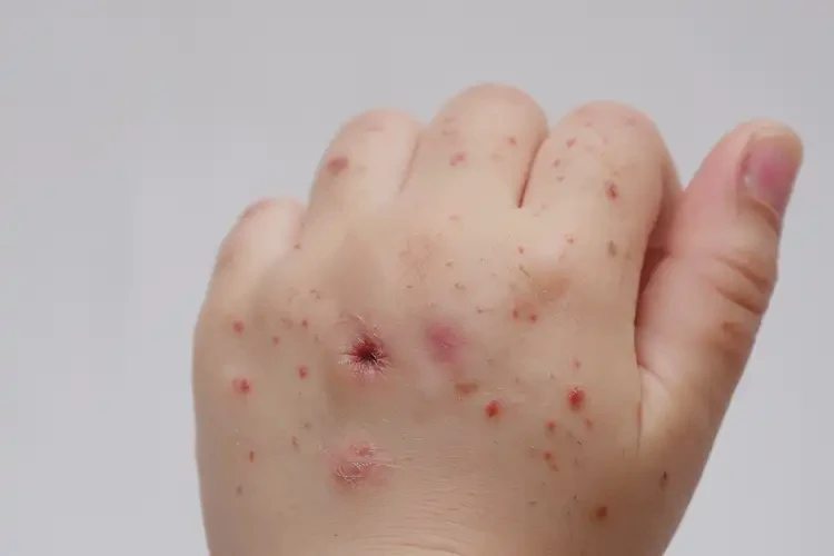 小儿手上经常长湿疹可以彻底自愈吗(图4)