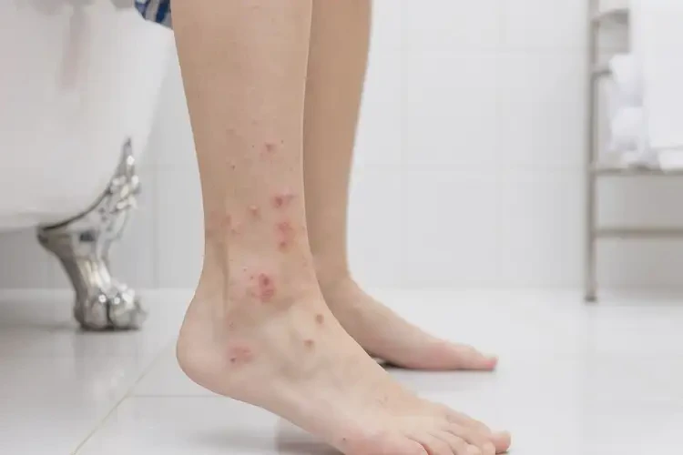 女生腳上偶爾起濕疹不管它會(huì)自己痊愈嗎(圖4)