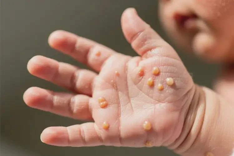 新生兒手上偶爾起濕疹不管它會自己好嗎(圖1)