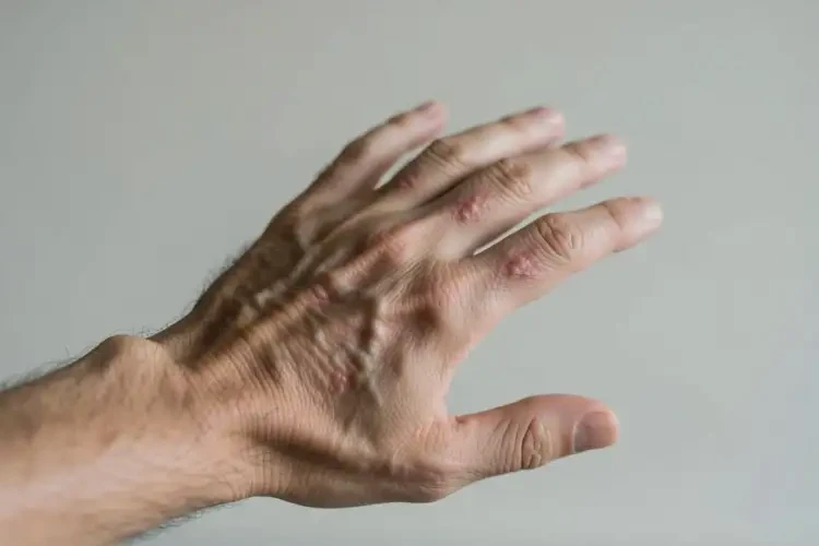 男人手上長(zhǎng)濕疹可不可以徹底自愈(圖1)