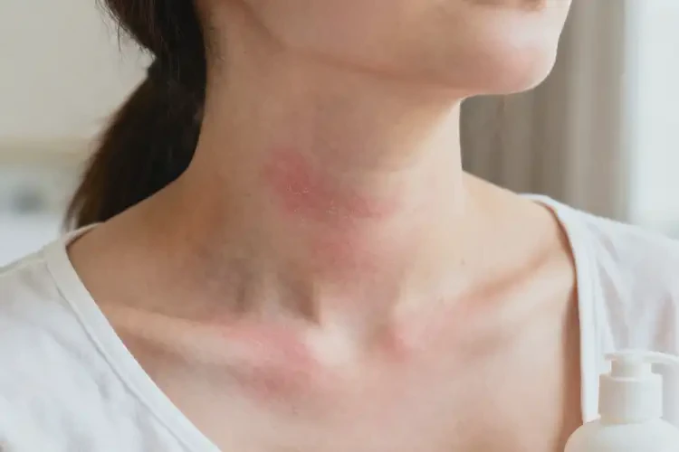 哺乳期媽媽脖子容易起濕疹能徹底自愈嗎(圖3)