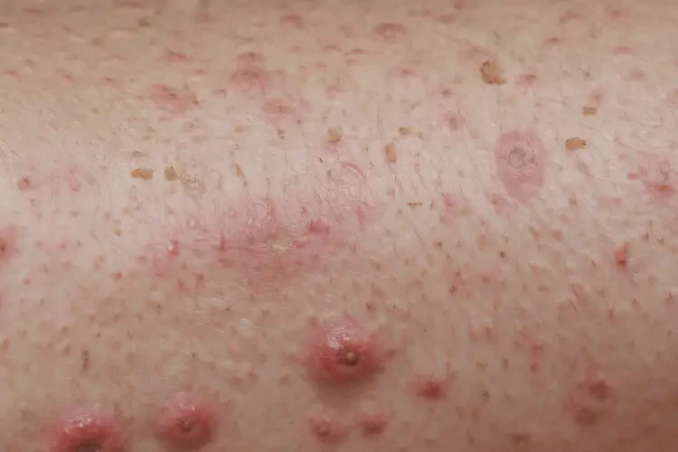 老年人大腿起濕疹能夠徹底治愈嗎(圖4)