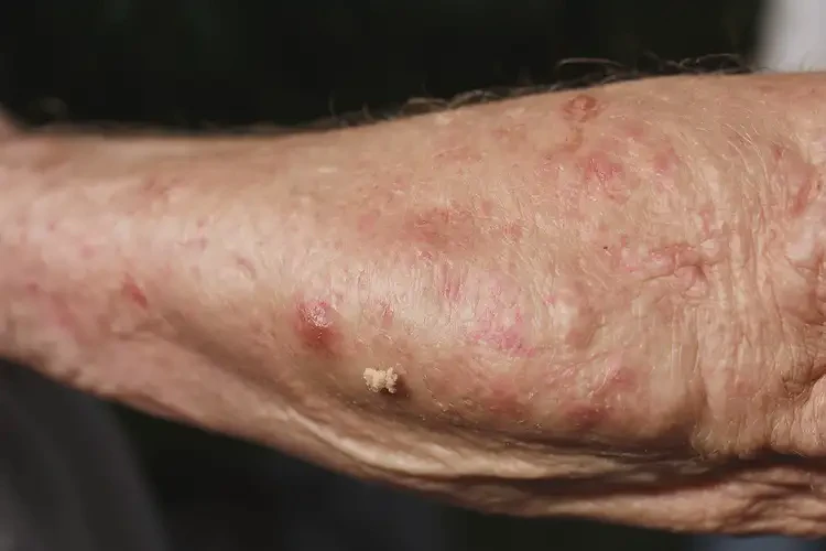 老年人手臂上出濕疹可以徹底自愈嗎(圖4)