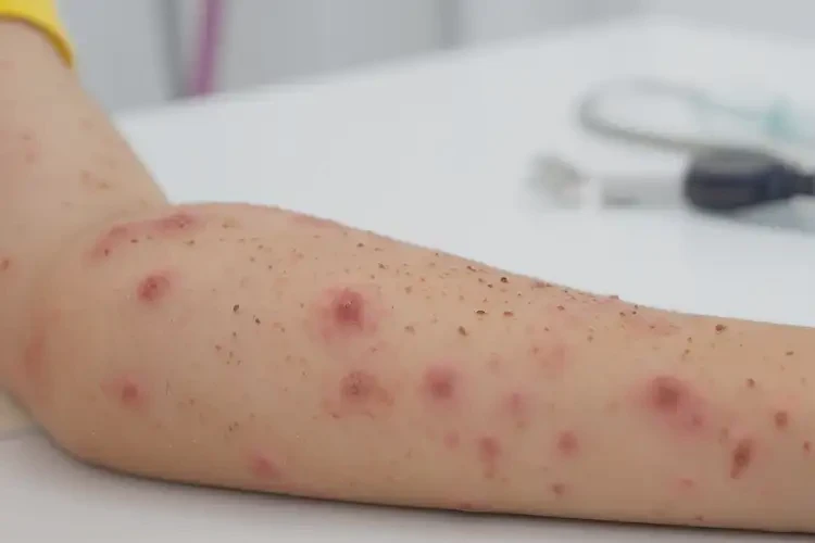 少兒手臂容易起濕疹能徹底自愈嗎(圖4)