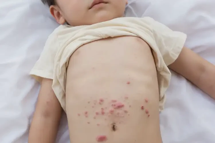 小孩肚子偶爾起濕疹能夠徹底治愈嗎(圖4)