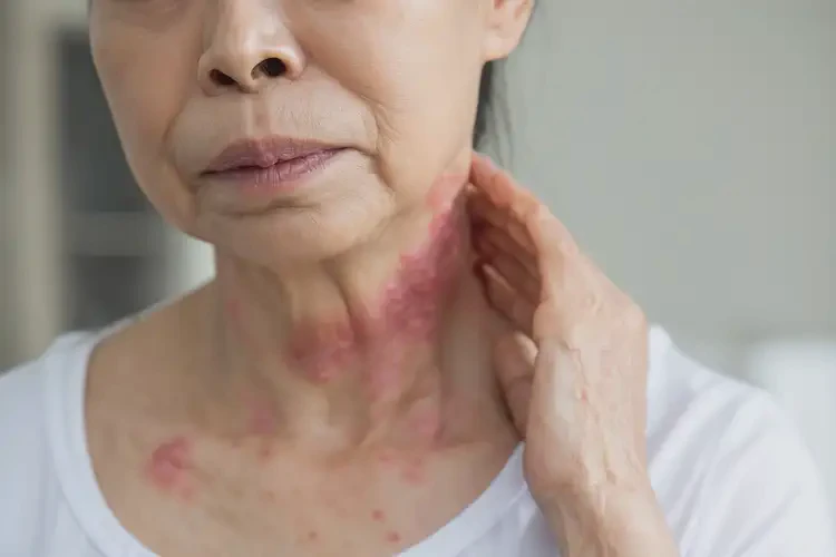 女人脖子出湿疹可不可以彻底自愈(图4)