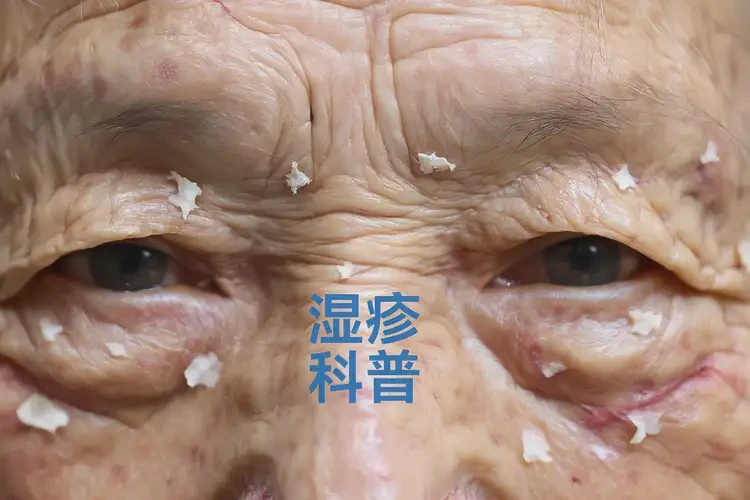 老人脖子有湿疹能靠自己自愈吗(图4)