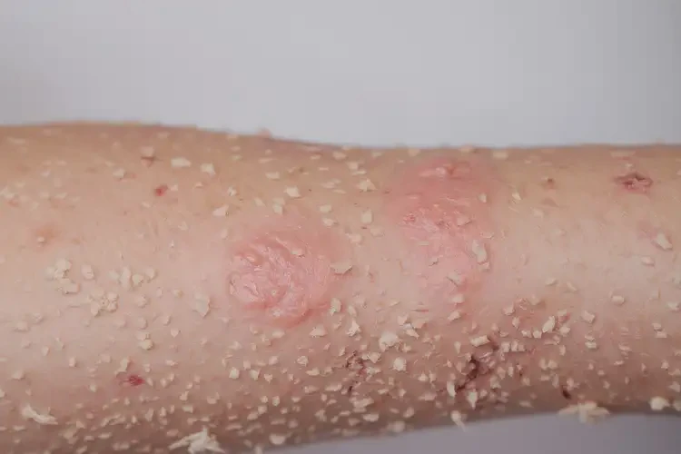 小孩手臂上容易起濕疹不管它會(huì)自己痊愈嗎(圖4)