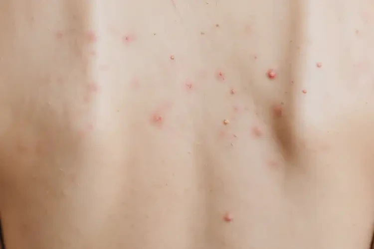 女生全身偶爾長(zhǎng)濕疹能徹底自愈嗎(圖4)