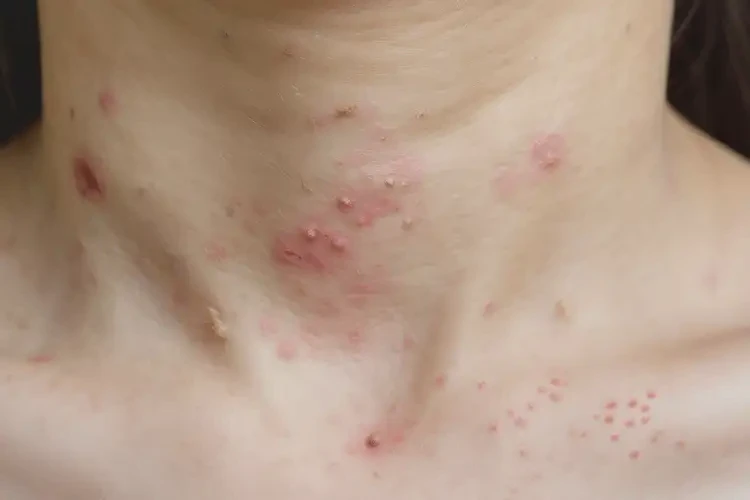 青少年脖子經(jīng)常長(zhǎng)濕疹能不能徹底自愈(圖4)