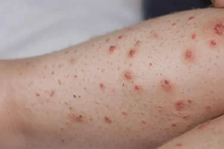 孩子大腿長濕疹能徹底自愈嗎(圖4)